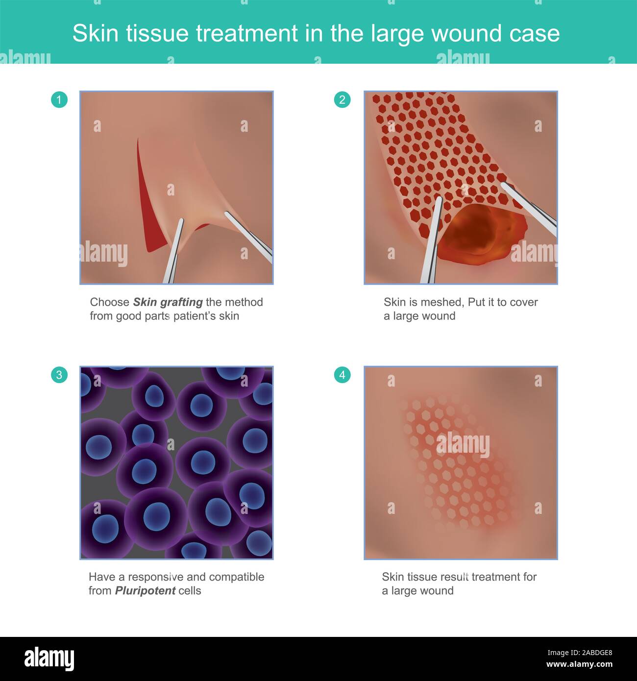 Skin tissue treatment in the large wound. Example illustration explain skin grafting tissue method treatment for large wound. Stock Vector