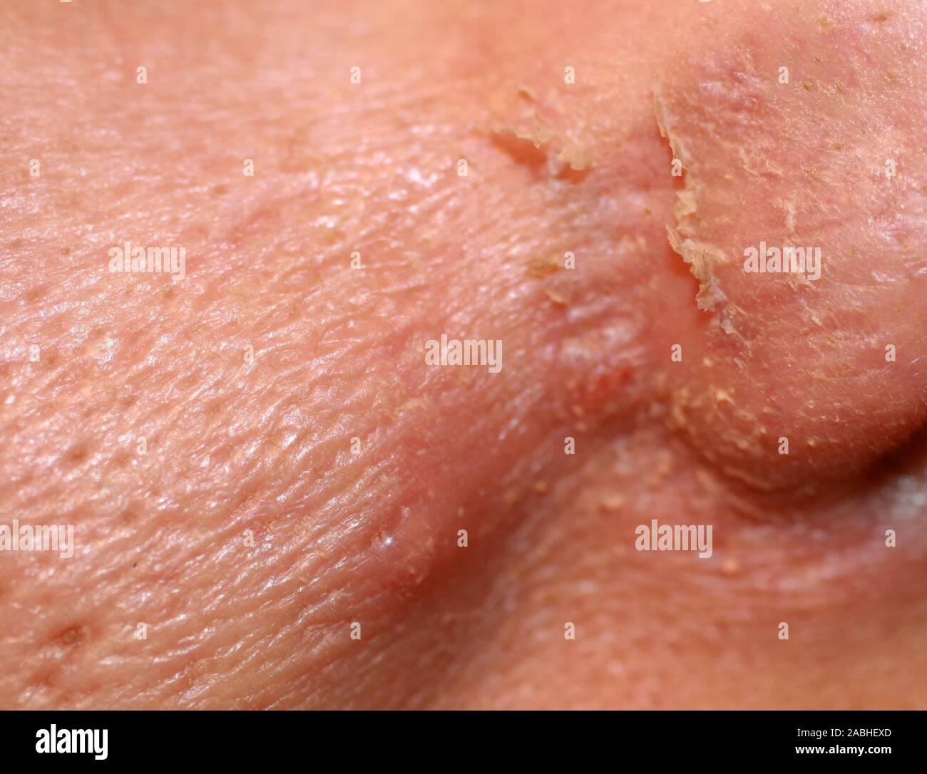 Inflamed skin on the face. Acne. Pimples on the skin. Scars and peeling