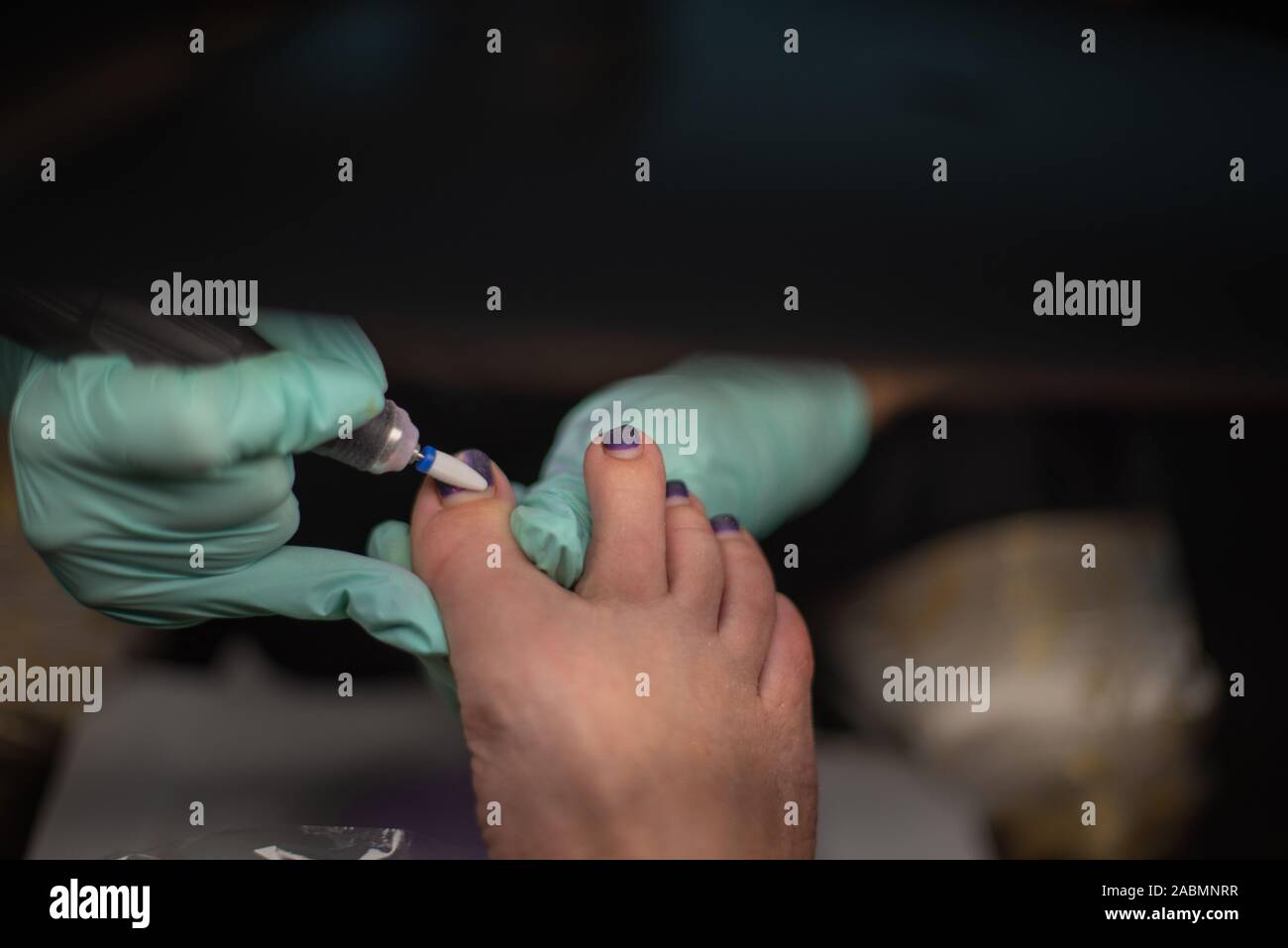 Onycholysis nail hires stock photography and images Alamy