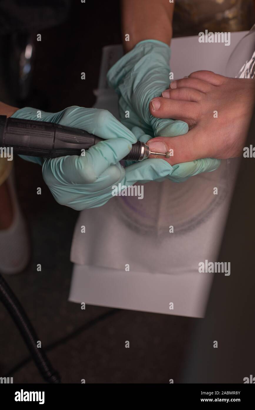 Onycholysis Nail High Resolution Stock Photography and Images - Alamy