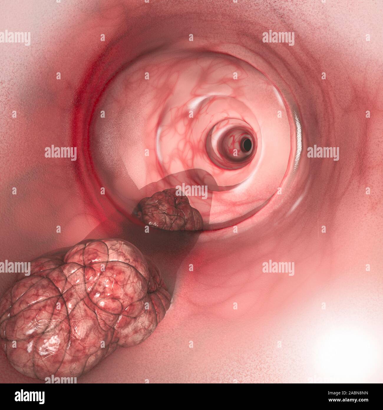 Internal view of the intestinal walls. Colorectal cancer (CRC), bowel cancer, colon cancer, or rectal cancer. Abnormal growth of cells Stock Photo