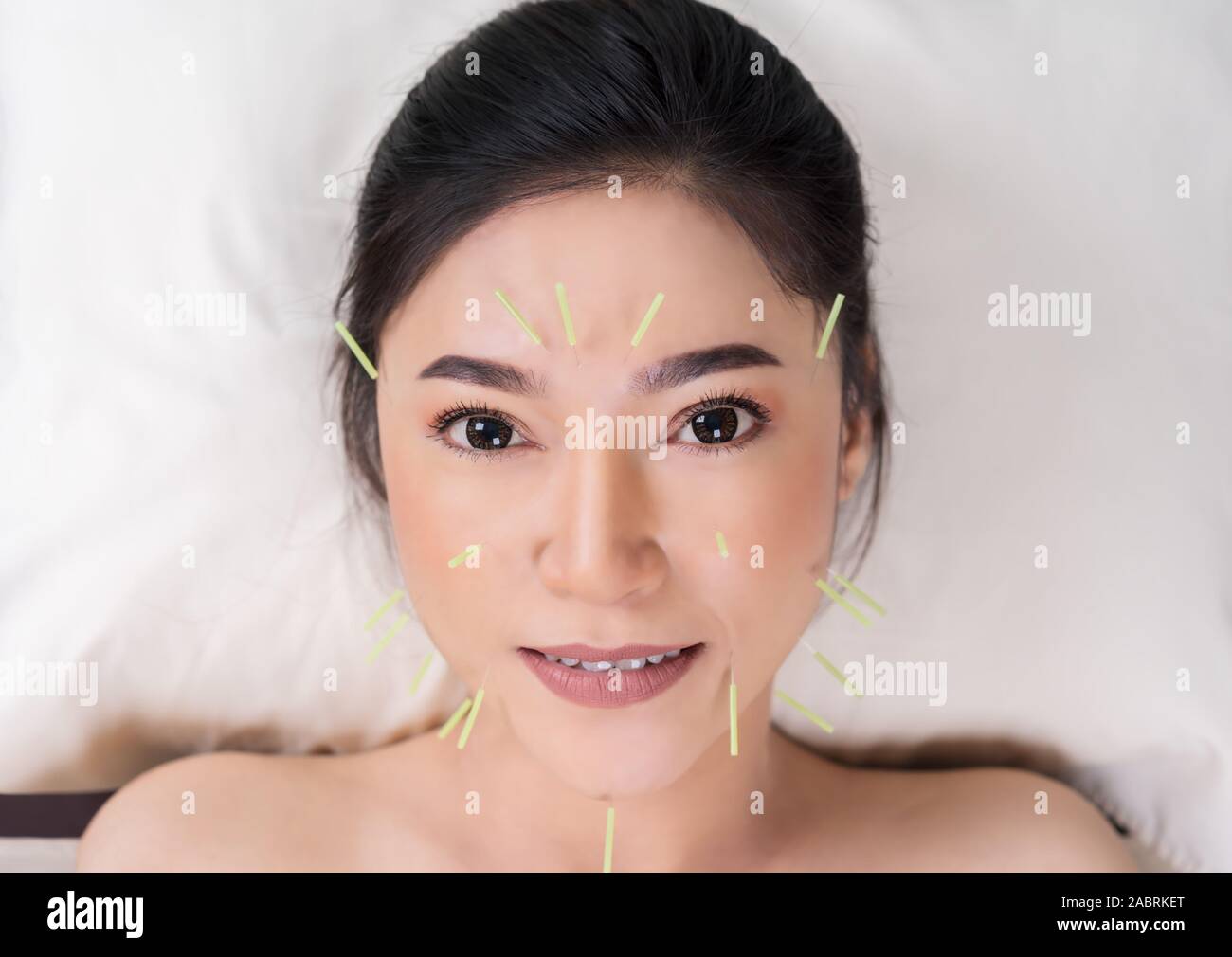 young woman undergoing acupuncture treatment on face Stock Photo Alamy