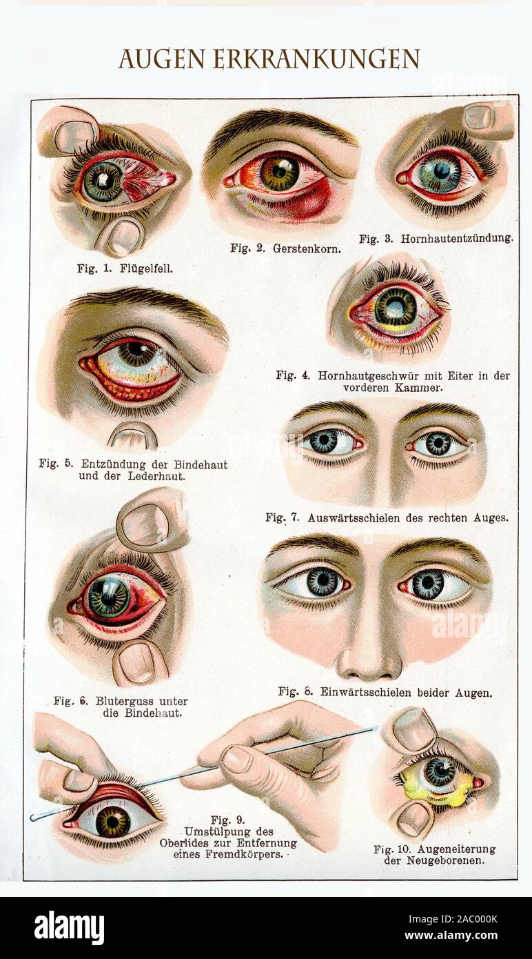 Healthcare and medicine: eyes diseases, inflammations and symptoms color illustration with German descriptions Stock Photo