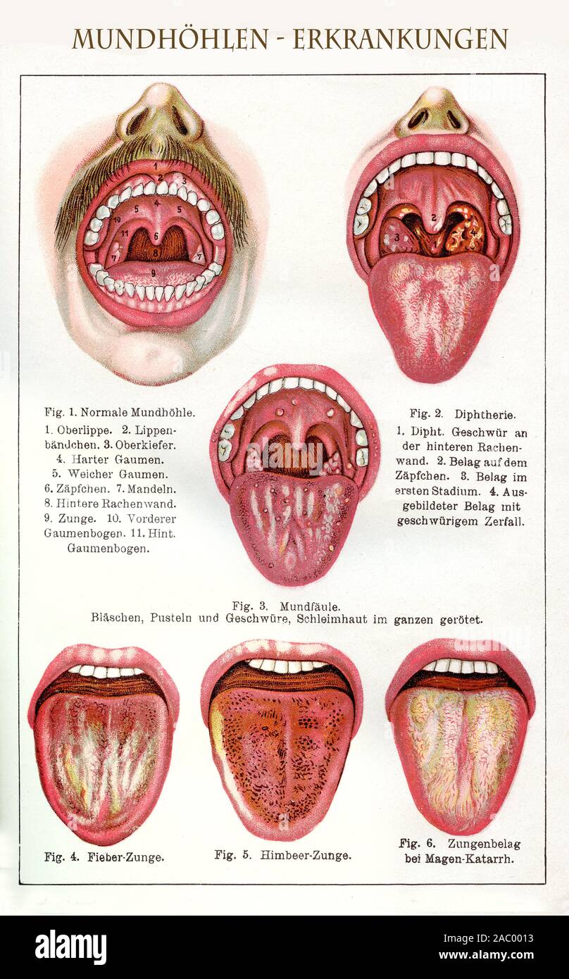 Healthcare and medicine: color table with German description of mouth diseases, illness and symptoms Stock Photo