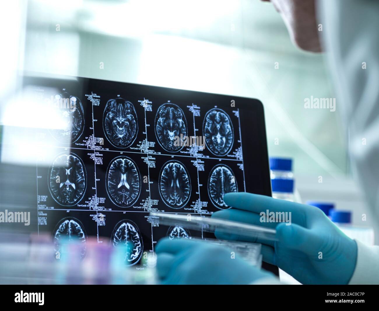 Dementia brain scans hi-res stock photography and images - Alamy