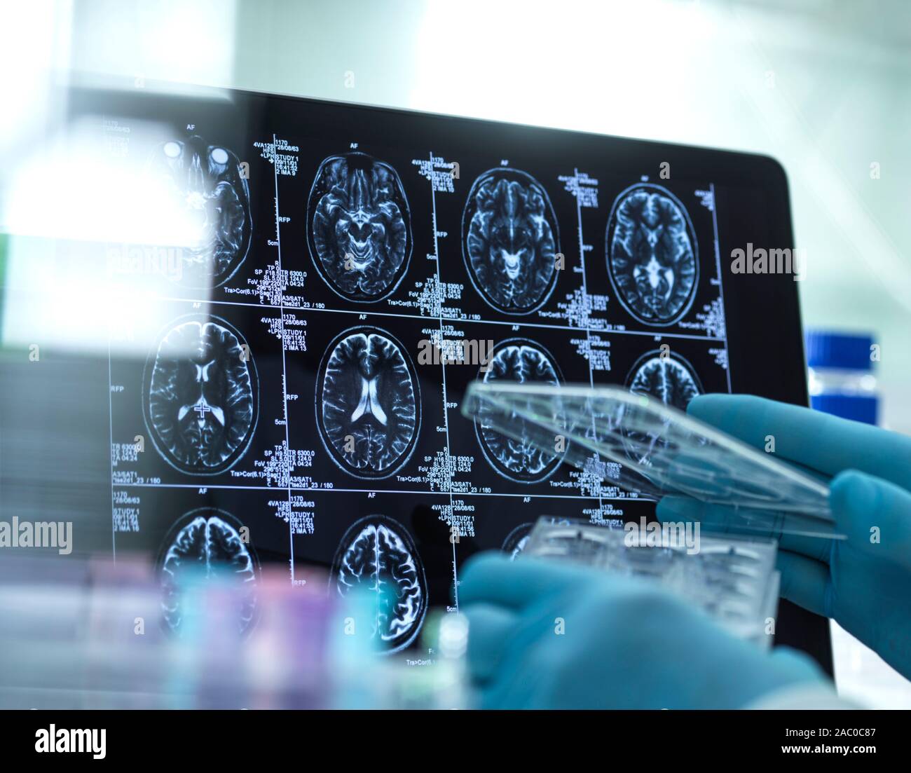 Dementia brain scans hi-res stock photography and images - Alamy