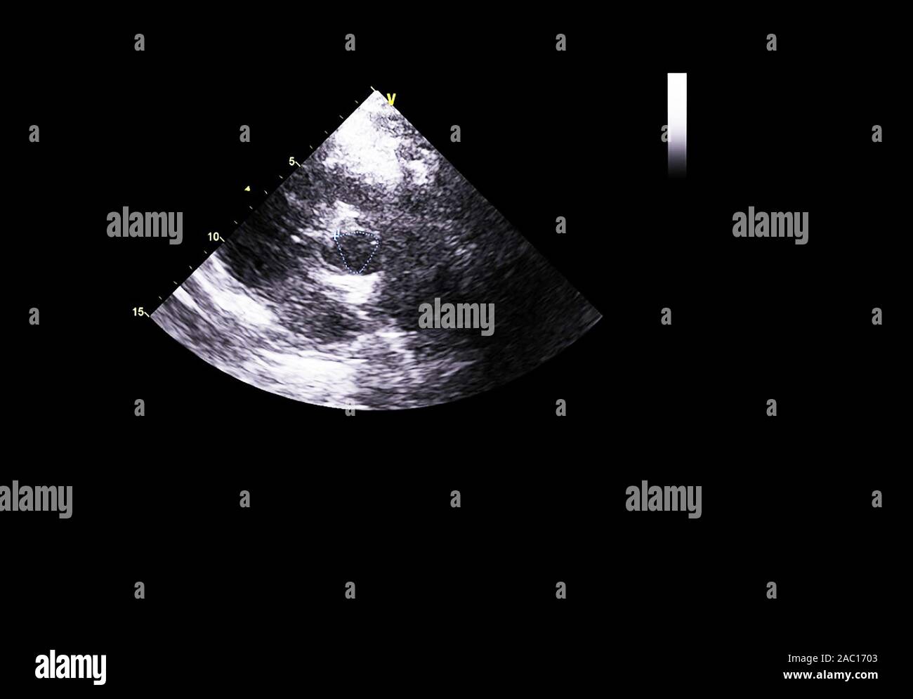 Color doppler ultrasound hi-res stock photography and images - Alamy