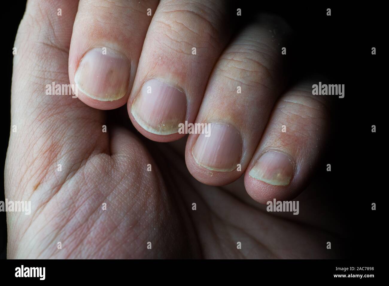 Psoriasis Nail Psoriasis Autoimmune Disease That Stock Photo 1183922908 |  Shutterstock