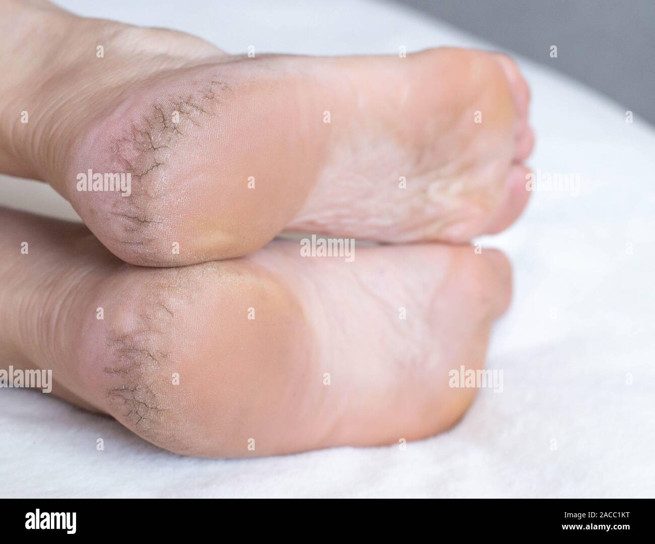 Dry cracked skin on the heels of a person s legs, closeup. The concept
