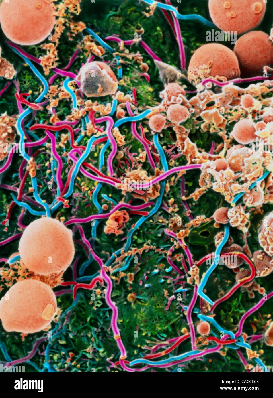 Lyme disease. Coloured scanning electron micrograph of the spirochaete