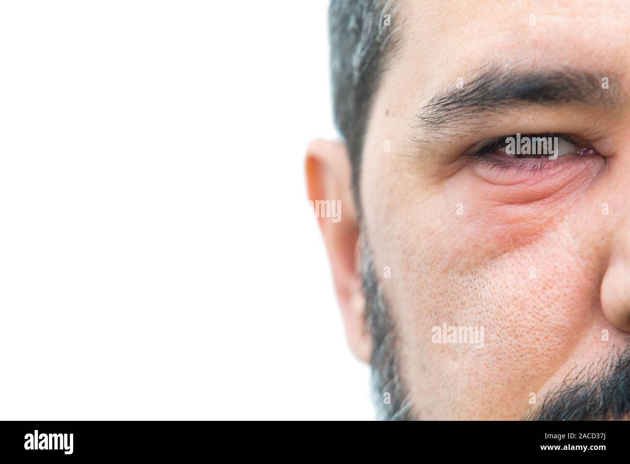 Man with stye in the eye with copy space for text Stock Photo