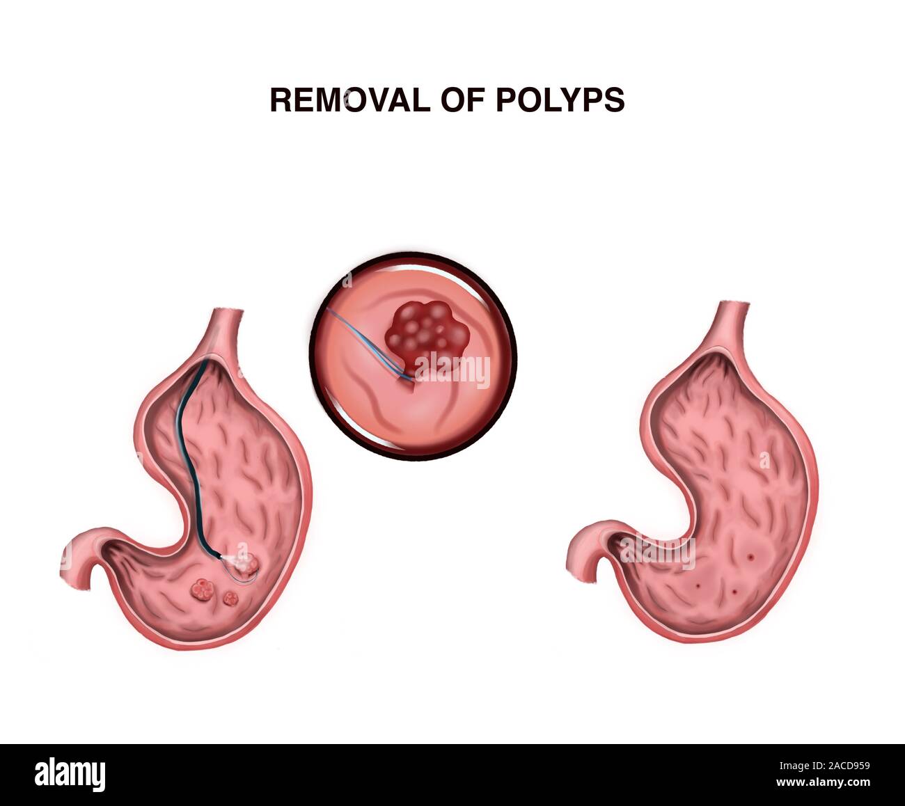 Illustration of removal of stomach polyps Stock Photo