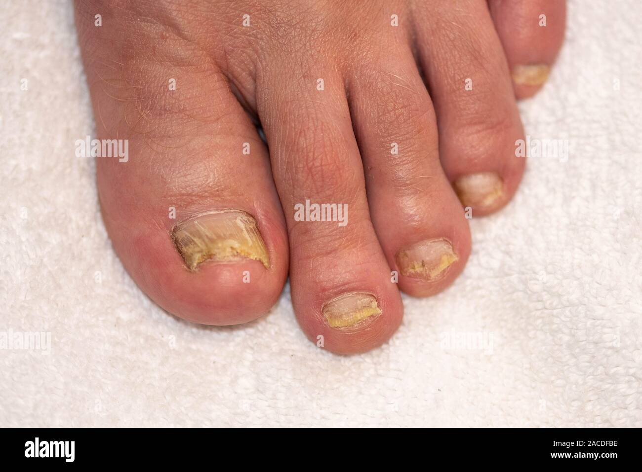 Tinea pedis hires stock photography and images Alamy