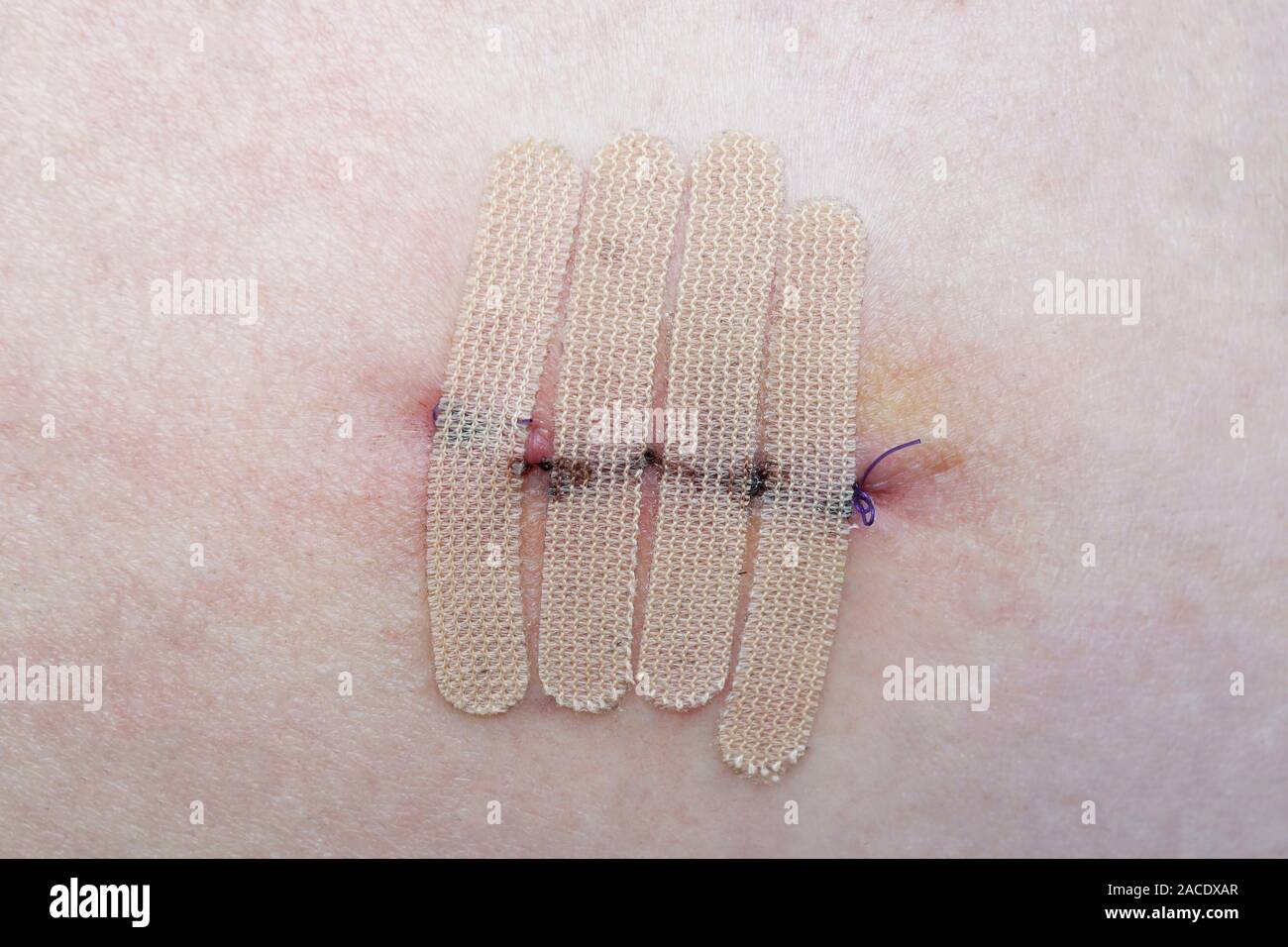 close-up of human skin with suture and wound closure strips or surgical tape after mole or melanoma biopsy Stock Photo