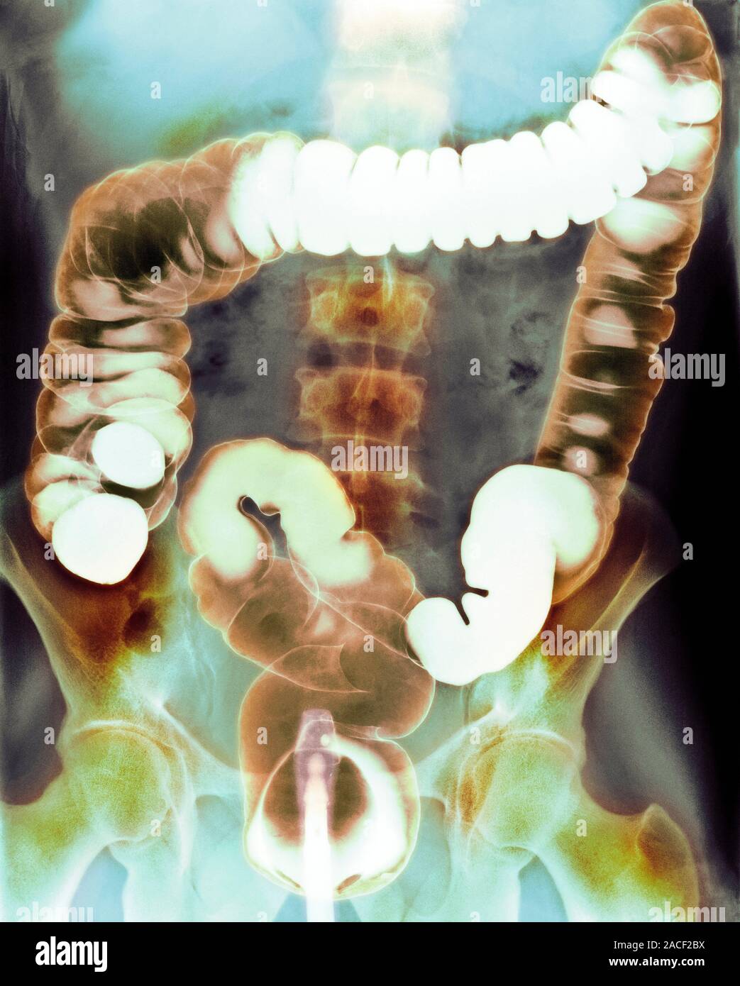 Healthy colon and rectum, coloured contrast barium enema Xray. The