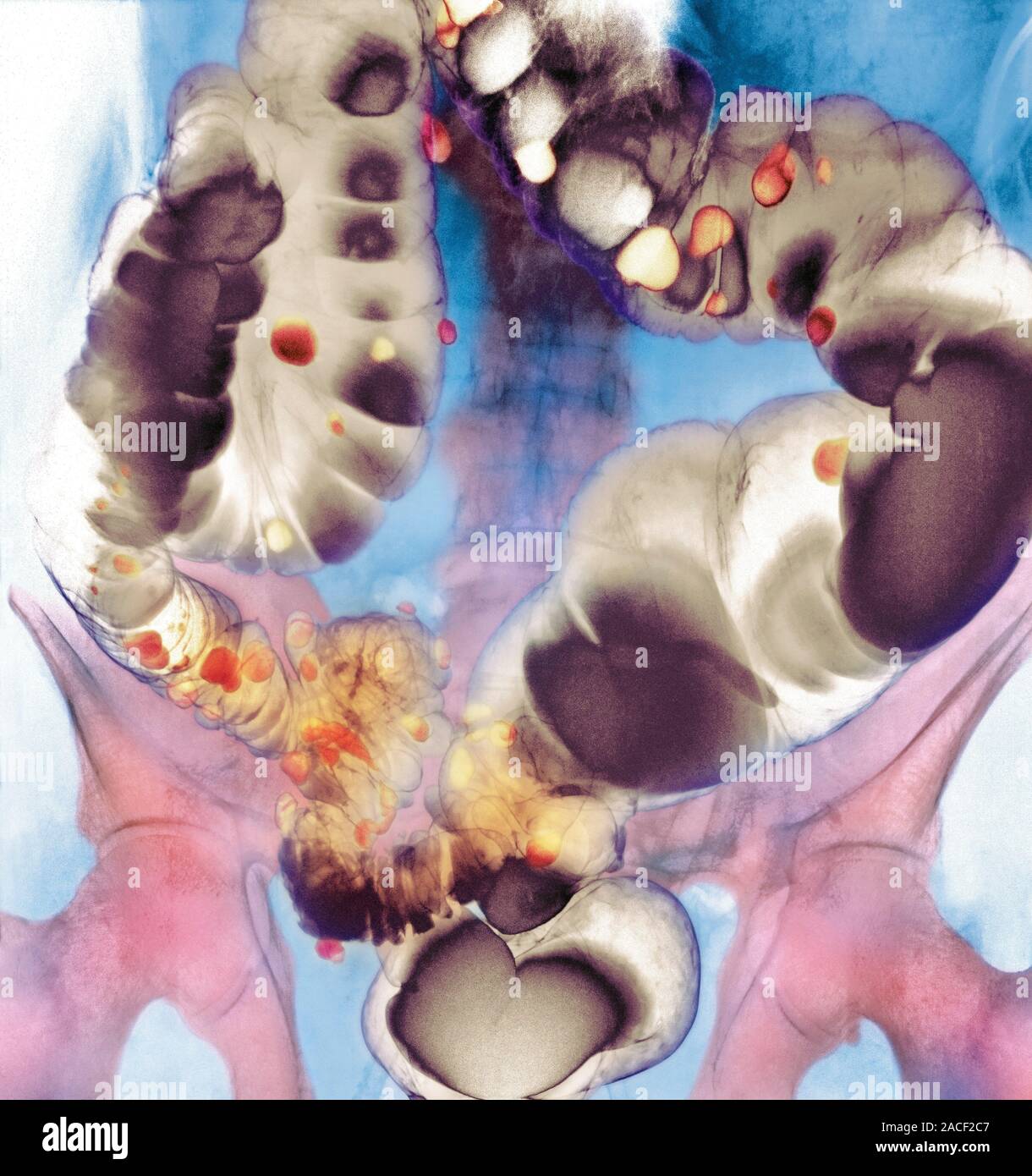 Diverticular Disease Coloured Contrast Barium Enema X ray Of The Large 