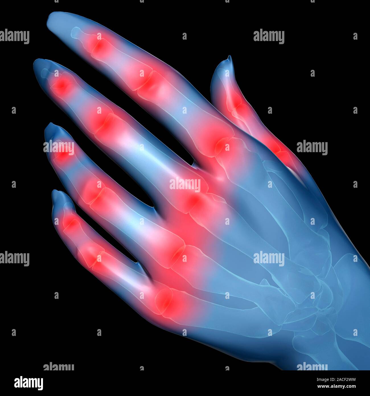 Knuckle pain. Conceptual computer artwork showing pain (represented as