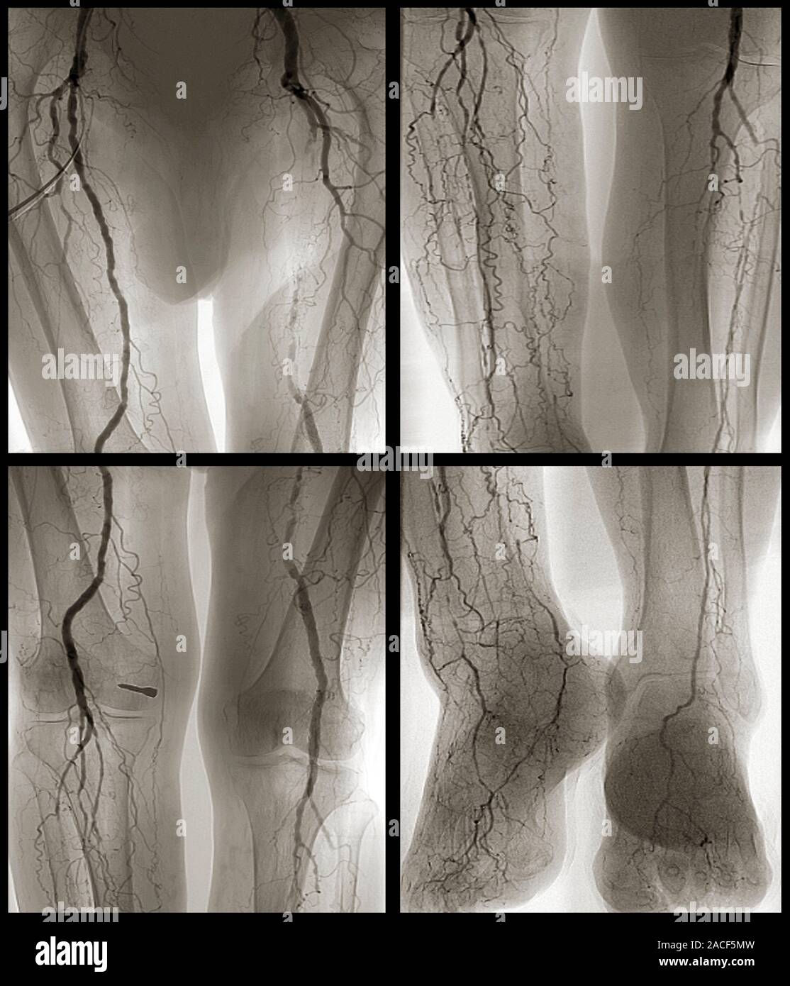 Arteritis. Angiogram of the back view of the legs of a 58 year old ...