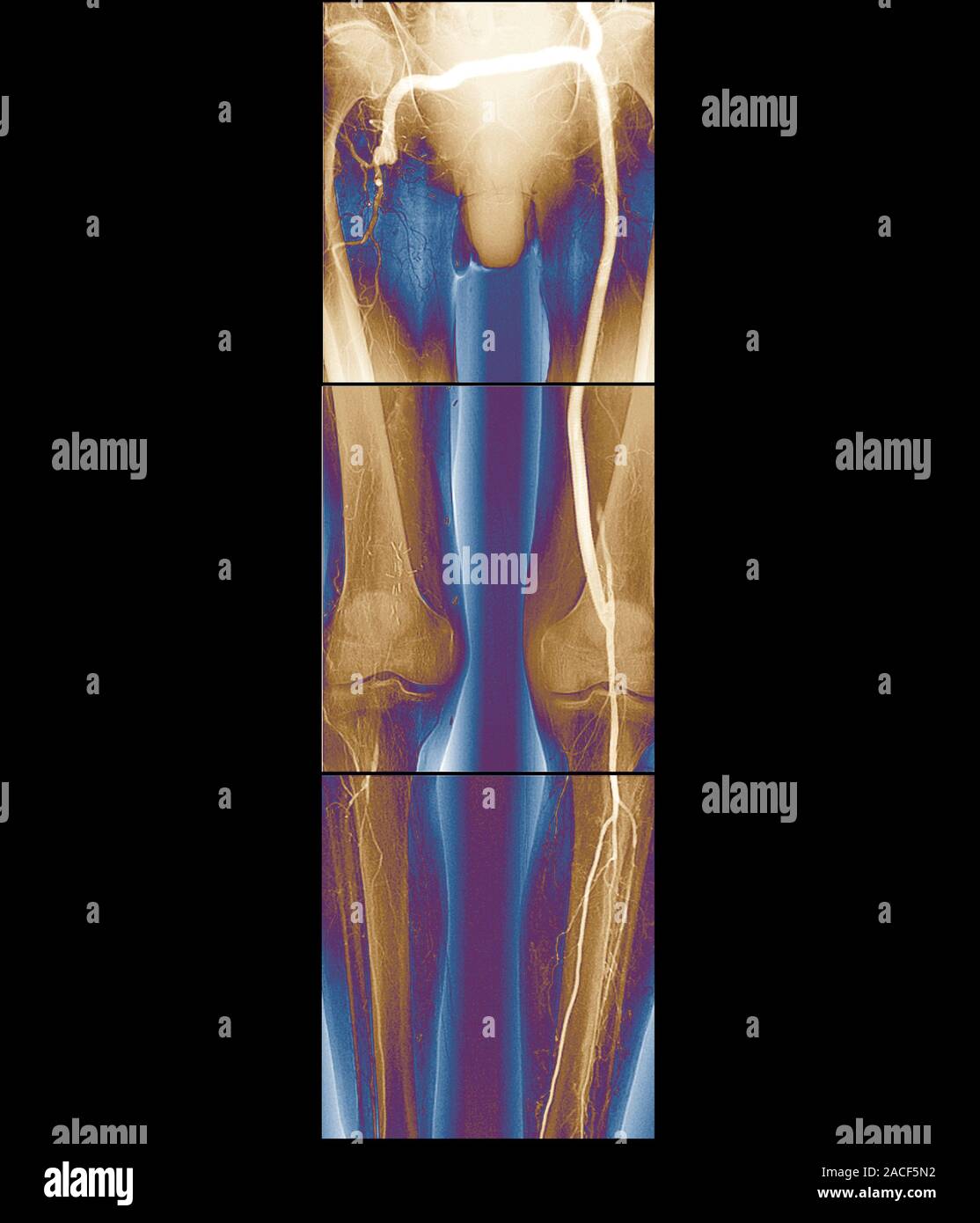 Angiogram In Leg Artery bypass surgery, coloured angiogram. Back view of the legs of a ...