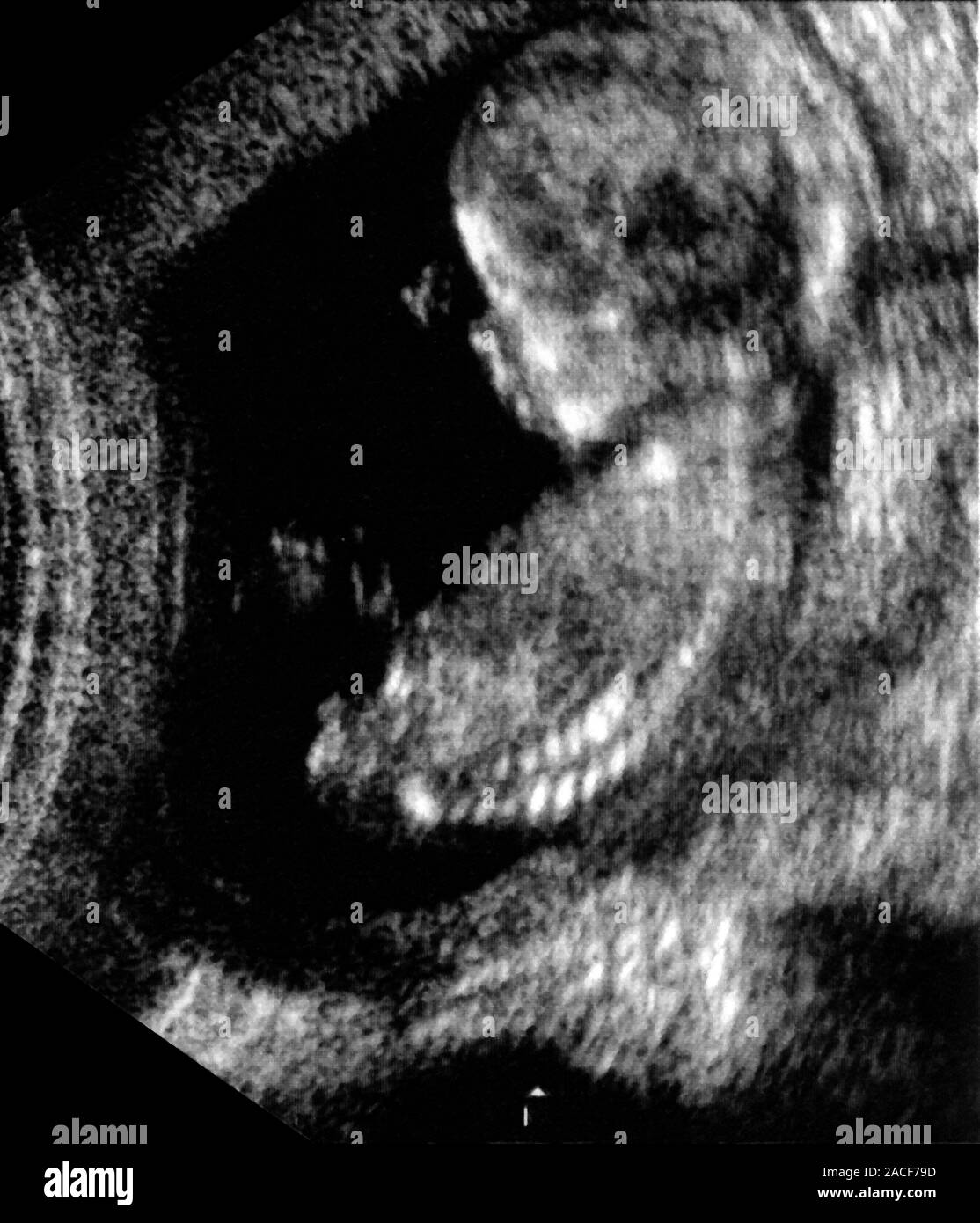 Узи ребенка на 13 неделе. Эмбрион на 13 неделе беременности УЗИ. УЗИ 13-14 недель беременности. Снимки УЗИ на 13 неделе беременности.