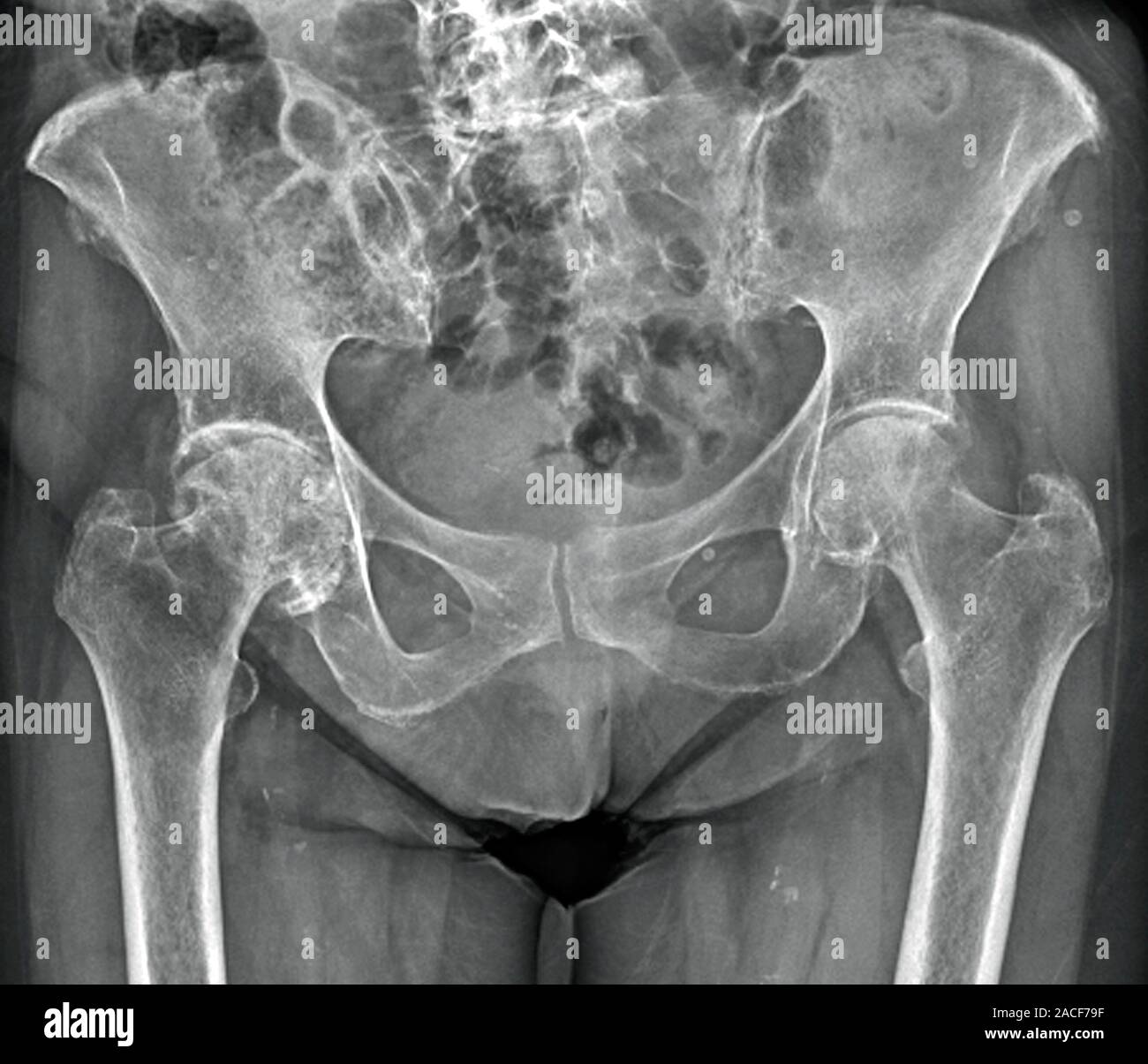 Osteoarthritis. Frontal X-ray of the pelvis of a 90 year old woman ...