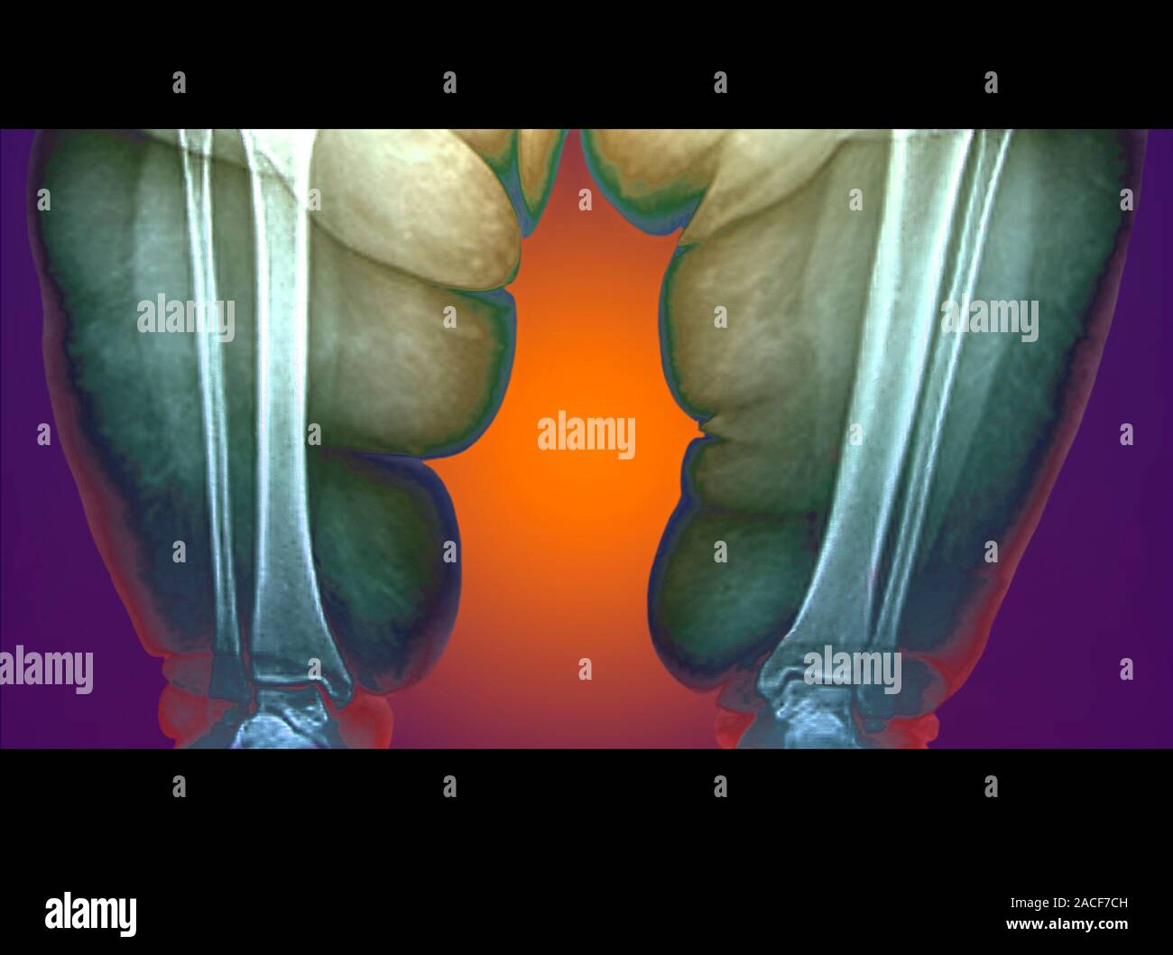 Obese person's lower legs. Coloured X-ray of the legs of a 23 year old ...