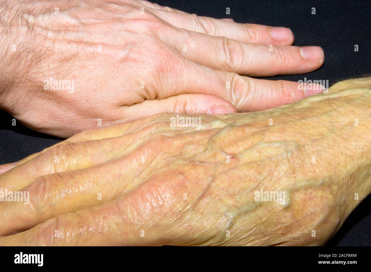 Jaundice. 81yearold man's hand (bottom) exhibiting jaundice as a result of taking the
