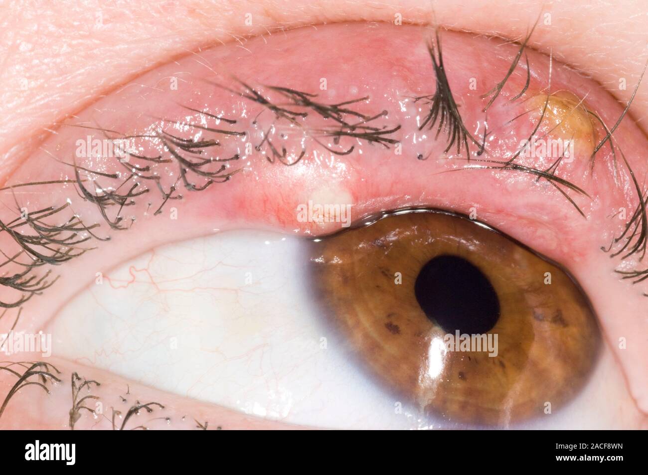 Eye abscesses on the upper eyelid of a 40yearold woman. These are