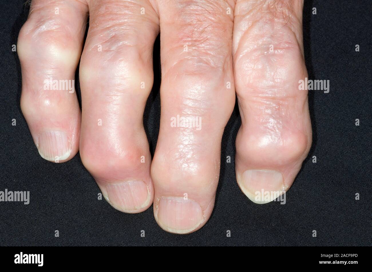 Osteoarthritis. Deformed fingers of an 80yearold man with