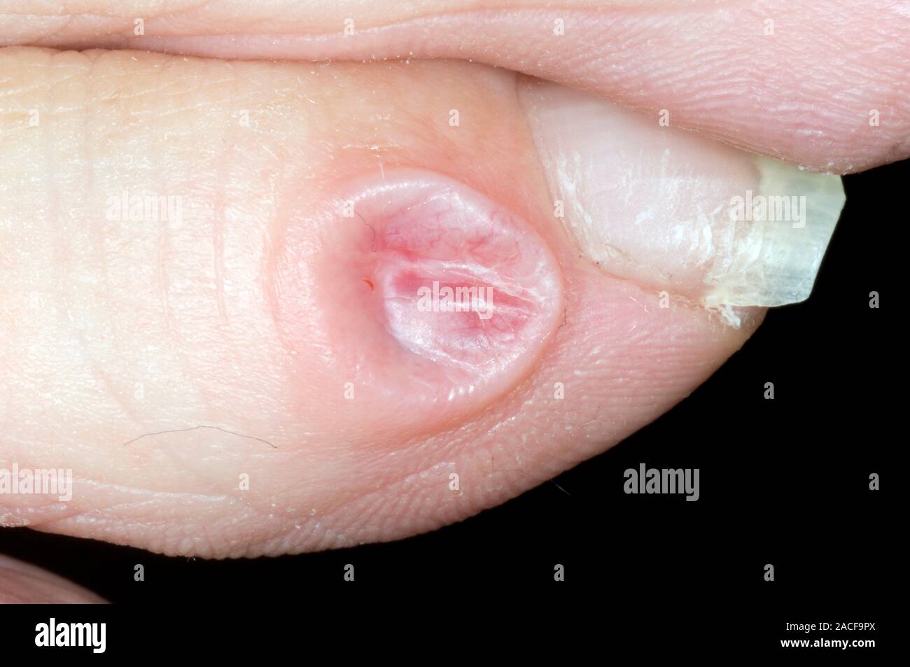 Synovial cyst. Image 2 of 2. Synovial cyst on the toe of a 58yearold