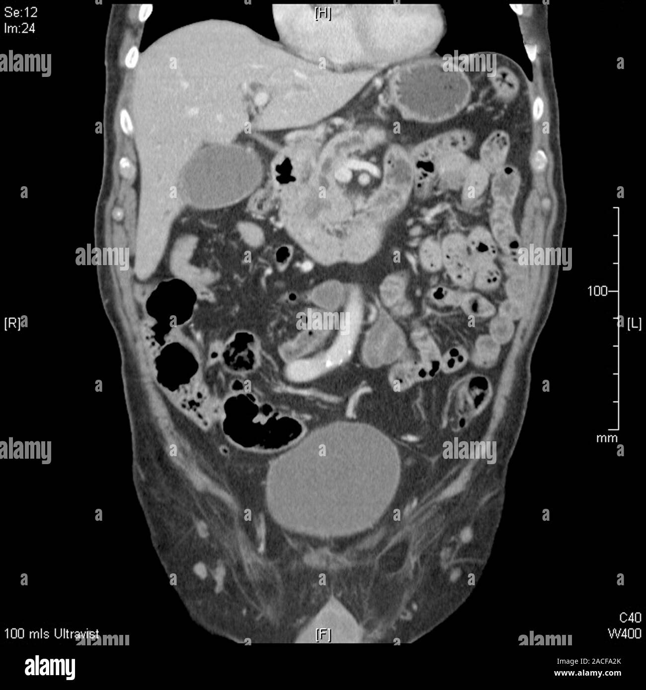 Рак поджелудочной метастазы в легких. Опухоль с метастазами поджелудочной железы. Опухоль с метастазами поджелудочной железы. Лимфома поджелудочной железы кт. Рак поджелудочной метастазы в легких.