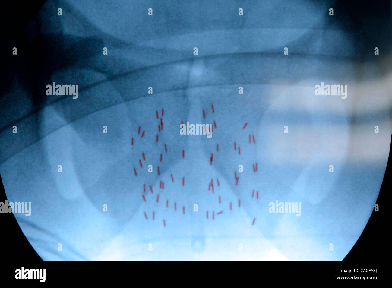 Prostate cancer radiotherapy surgery. X-ray of radioactive sources (red ...