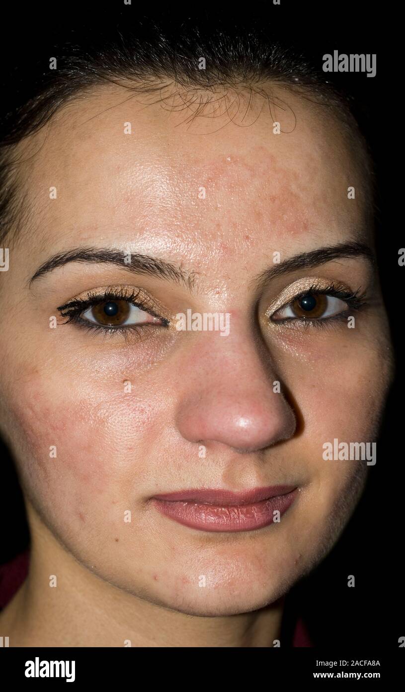 After acne scar treatment. Woman with reduced acne scarring on her