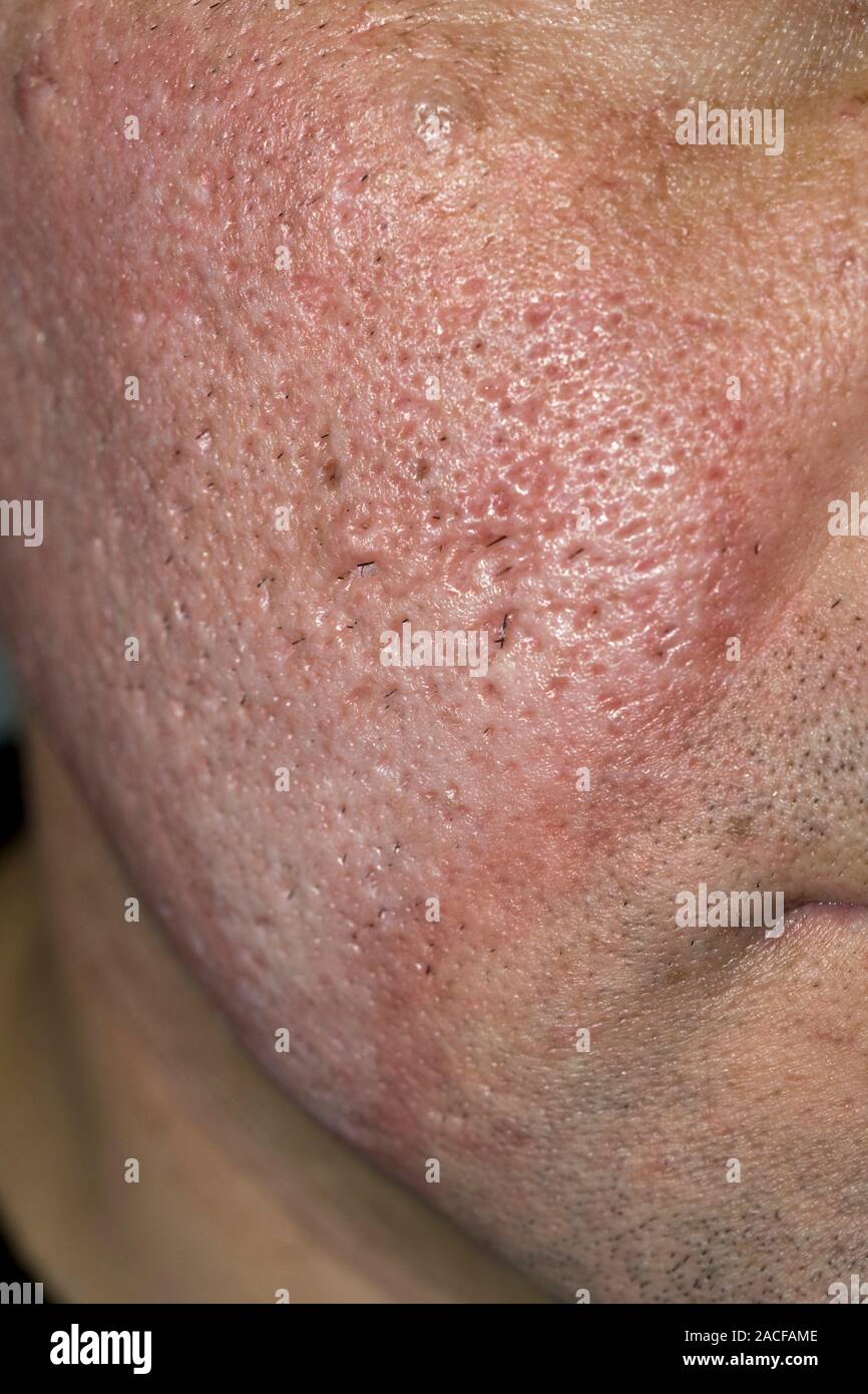 Acne scar treatment. Cheeks of a man with acne scarring, after