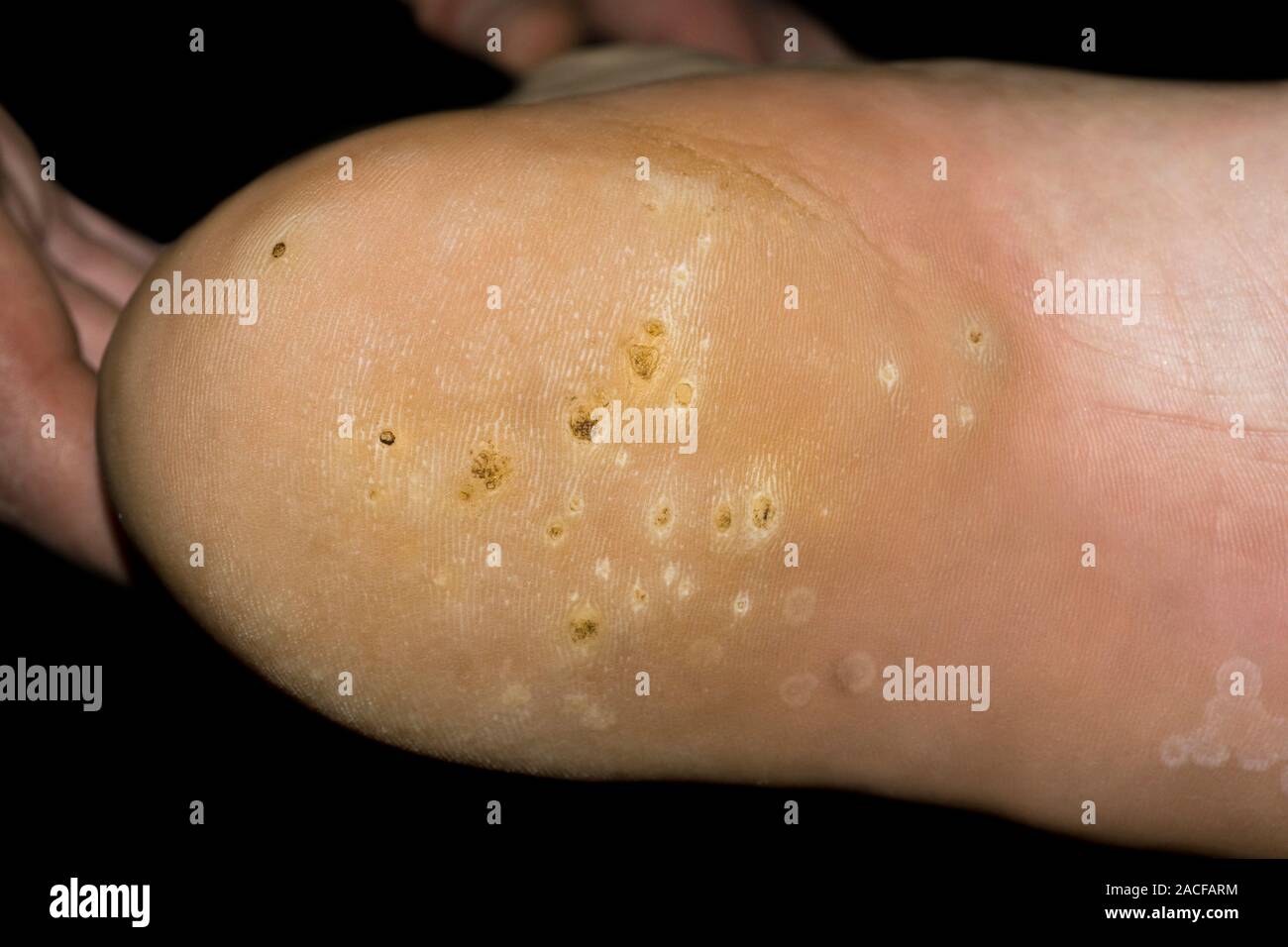 Verrucas (verruca plantaris) on the bottom of a patient's foot. Verrucas, also known as plantar
