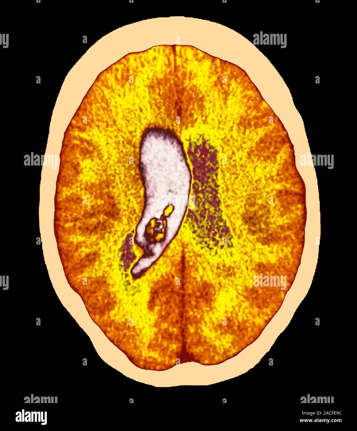 Brain haemorrhage, coloured computed tomography (CT) scan. The front of