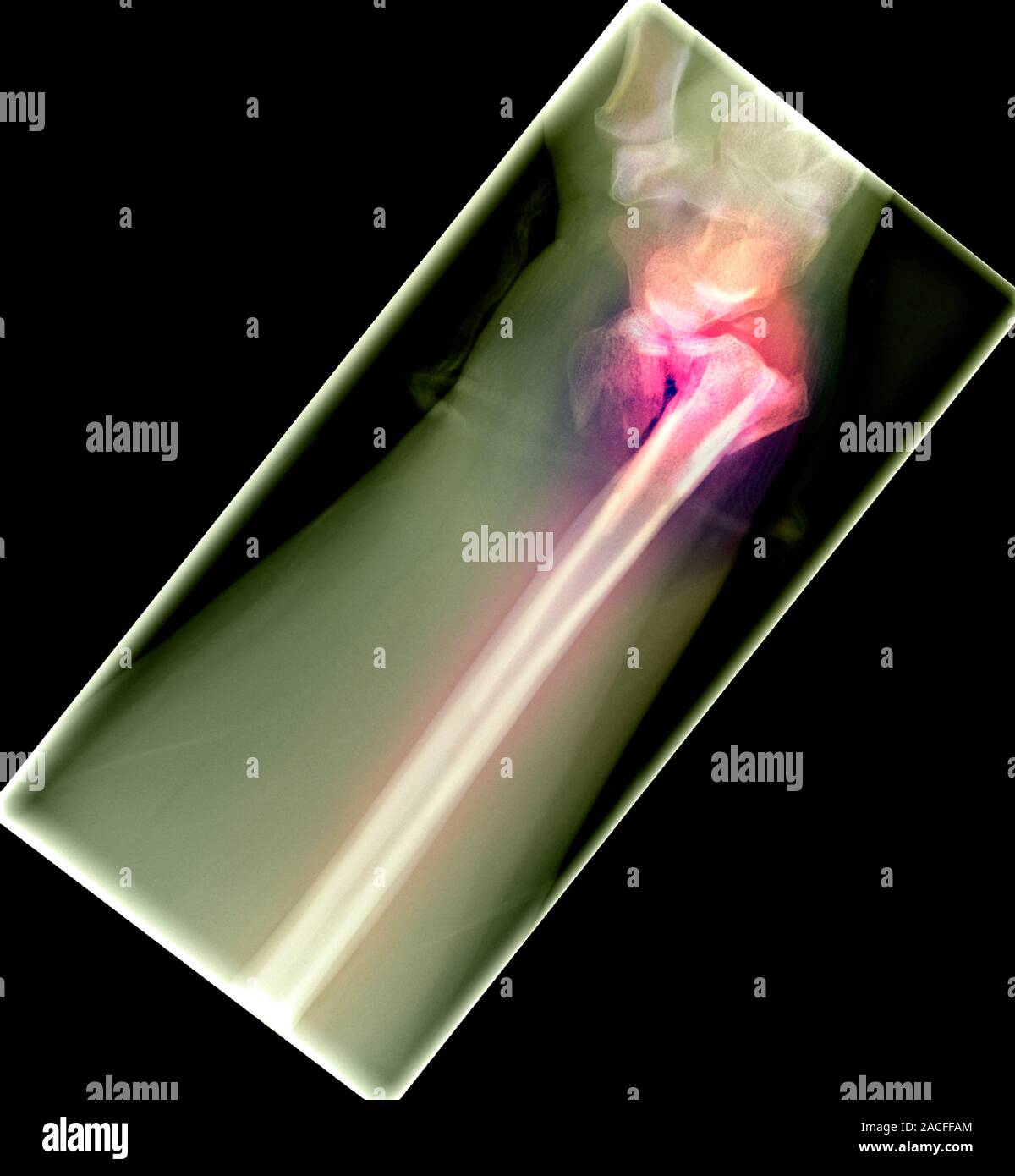 Broken wrist. Coloured Xray of a comminuted fracture of the distal
