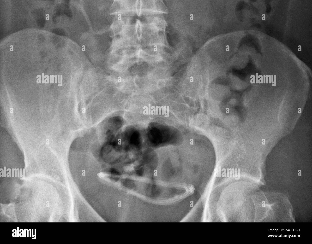 Ectopic hydrocephalic shunt. Xray of the pelvis of a patient, showing