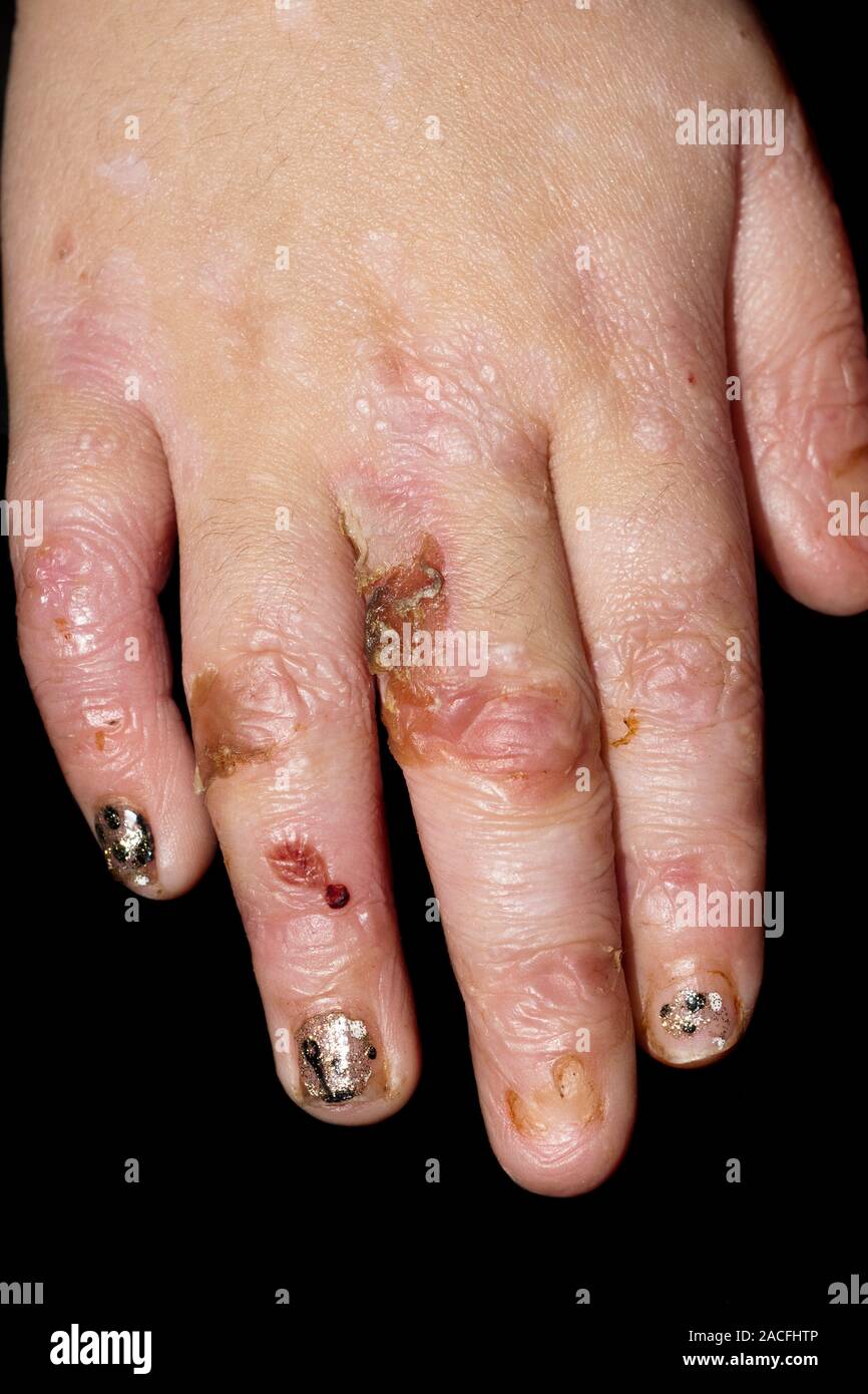 Epidermolysis bullosa. Hands of a three year old girl with