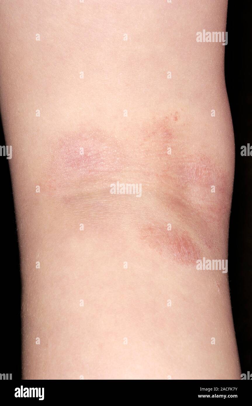 Atopic eczema affecting the skin on the back of a 3 year old boy's knee
