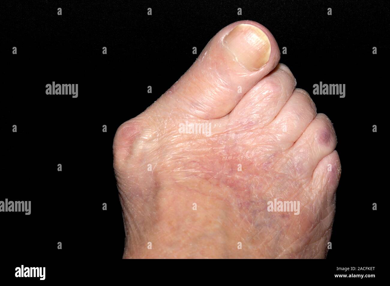 Bunion. Foot of a 94 year old woman with a severe bunion (hallux valgus ...