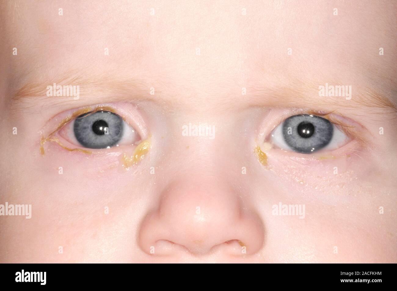 Acute bacterial conjunctivitis in a 3 year old boy with pus (yellow) around his eyes. This