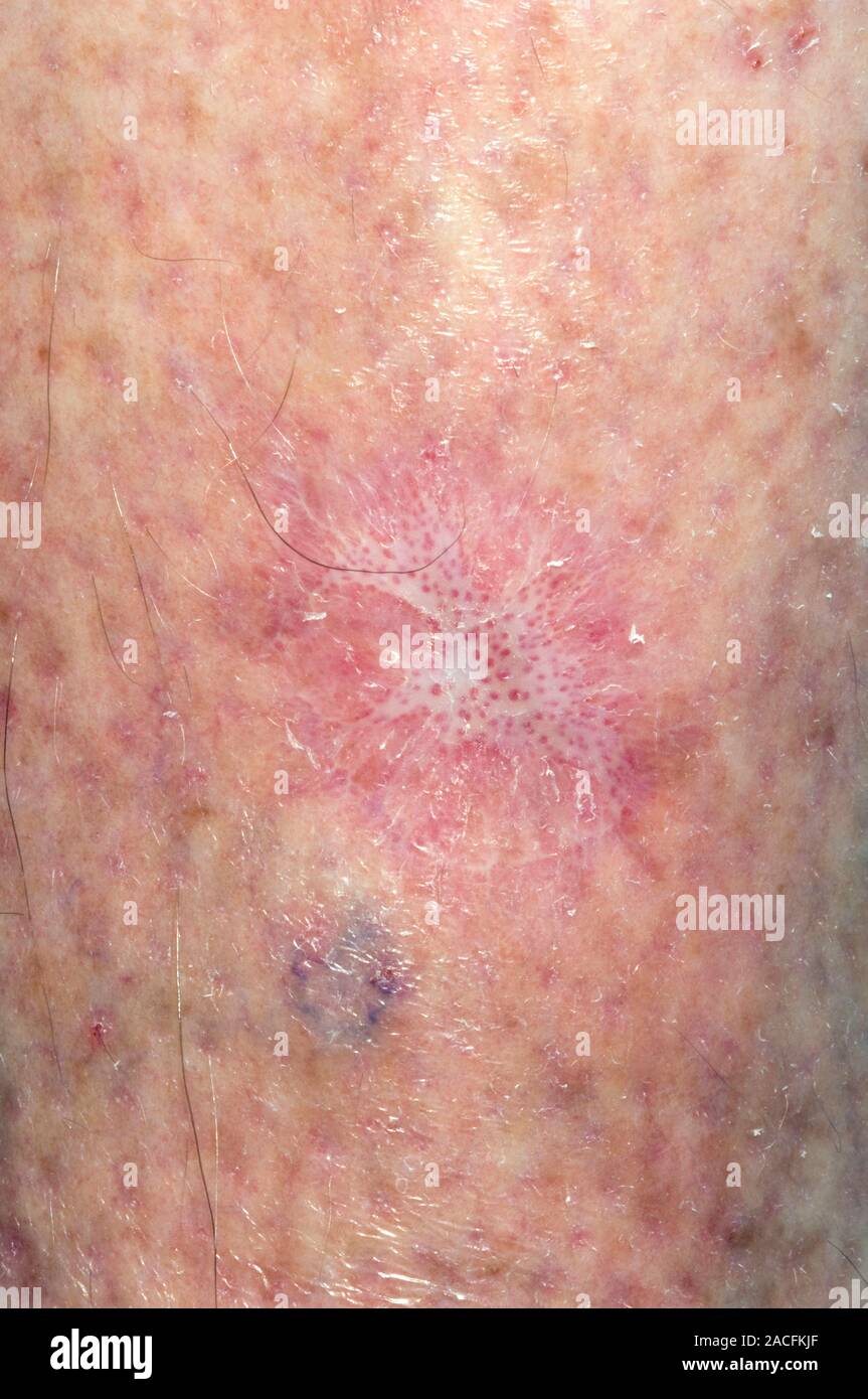 Healing skin graft scar on the shin of a 65 year old man. Skin grafts