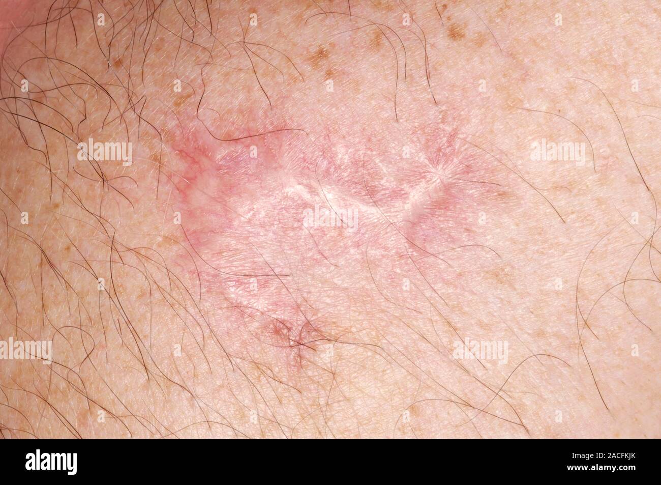 Skin cancer scar. Healed scar on a 64 year old man's shoulder after
