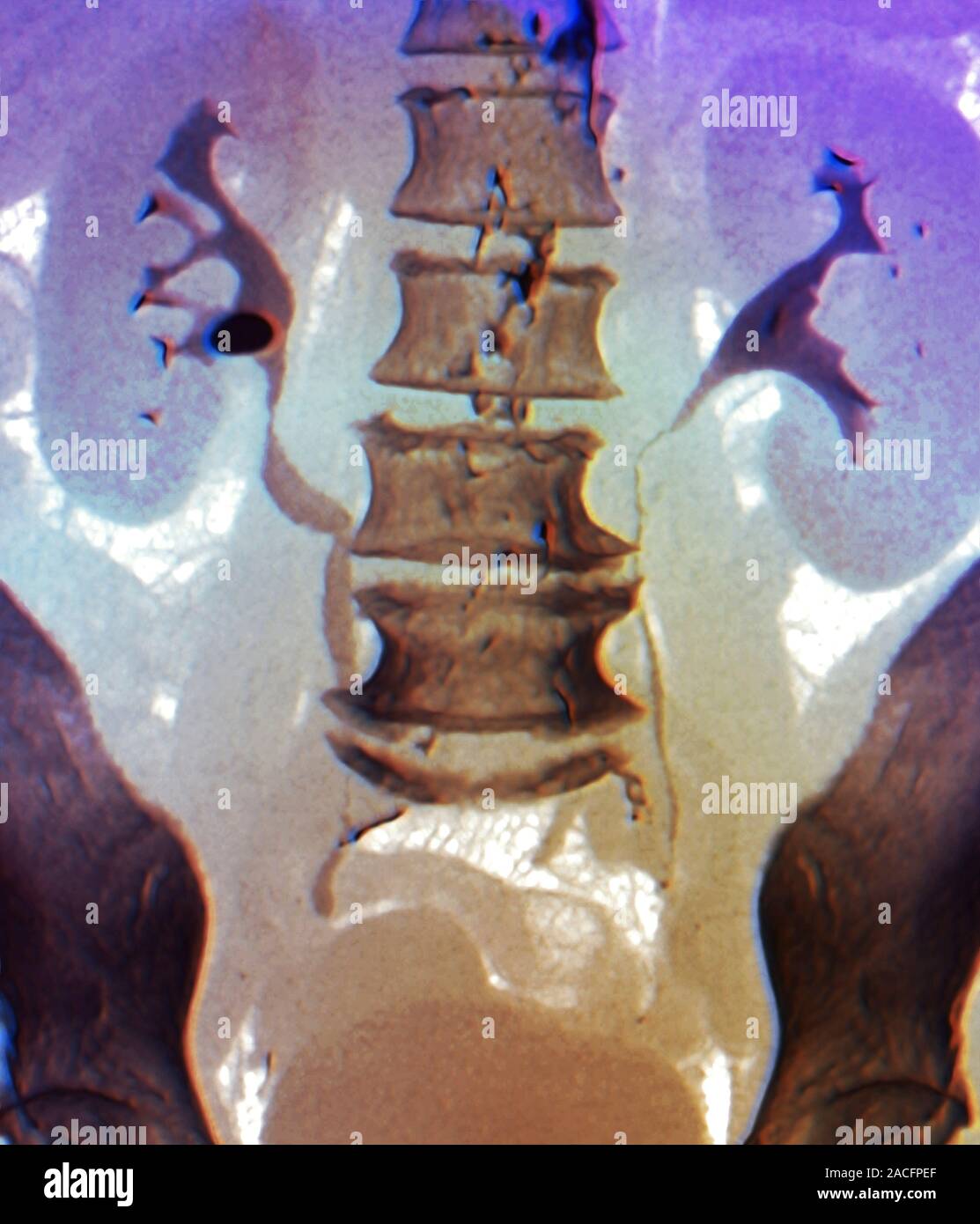Coloured computed tomography (CT) scan of the abdomen of a patient aged ...