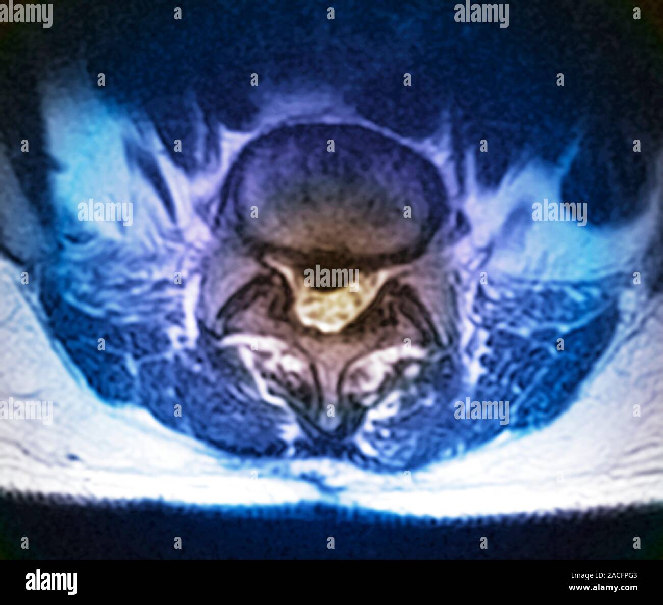 Coloured magnetic resonance imaging (MRI) scan of an axial (horizontal ...