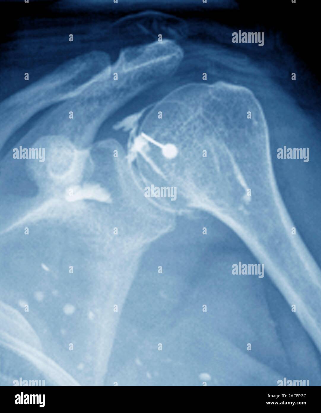 Coloured Xray of the shoulder joint of a patient aged 51, showing the