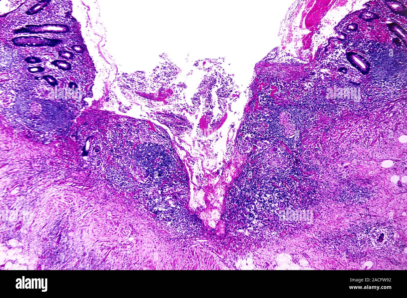 Crohn's disease. Light micrograph of a section through the lining of