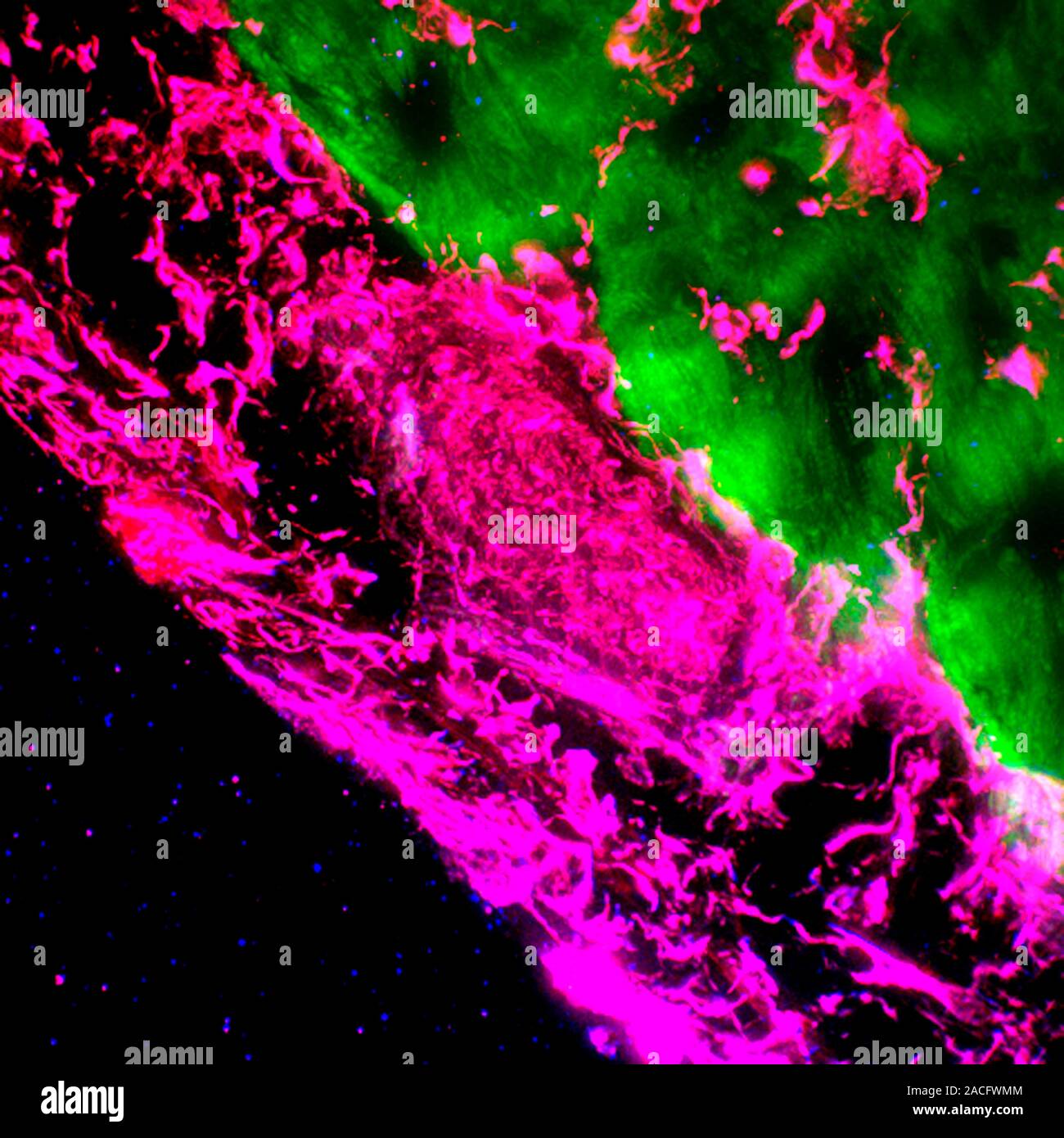 Heart failure. Fluorescent deconvolution micrograph of endothelium ...