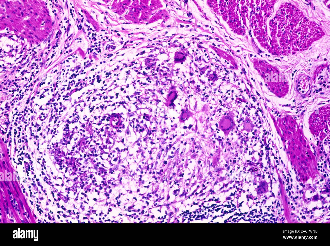 Crohn's disease. Light micrograph of a section through a large